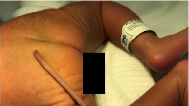 Bebé prematuro nace con una cola de 12 centímetros