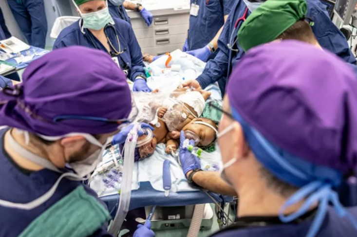 25 médicos logran separación de siamesas tras innovadora cirugía en Texas