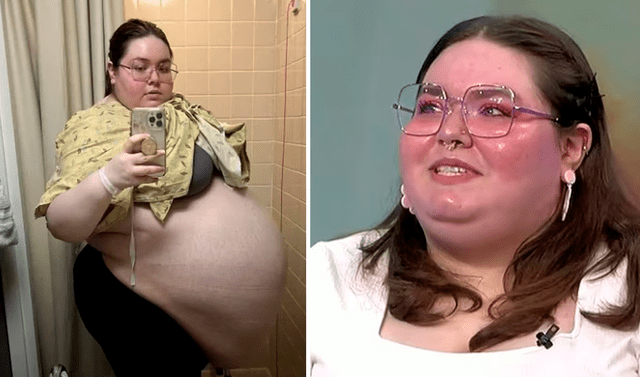 Mujer pensó que tenía sobrepeso pero se trataba de un quiste de 50 kilos