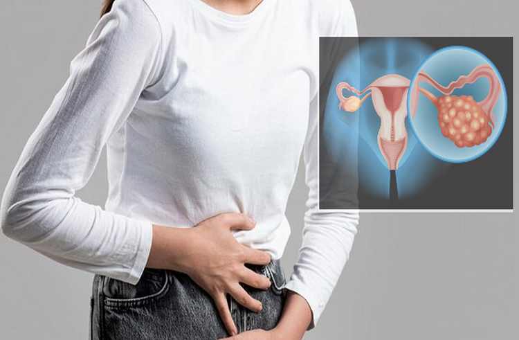 Día Mundial del Cáncer de Ovario:  75% de las mujeres solo son diagnosticadas una vez que la enfermedad se ha propagado