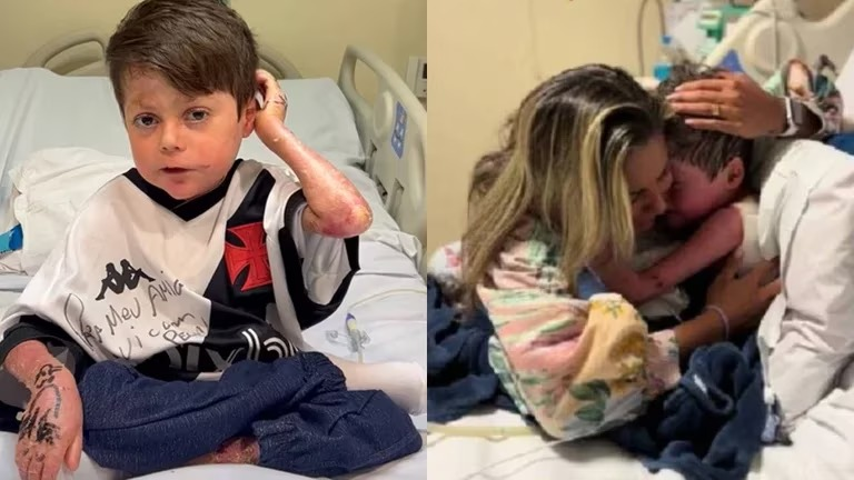 Niño con “piel de mariposa” despertó tras 16 días en coma