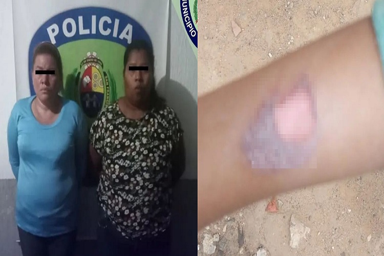 Detenidas dos mujeres por quemar con una cuchara caliente a una niña de cinco años 