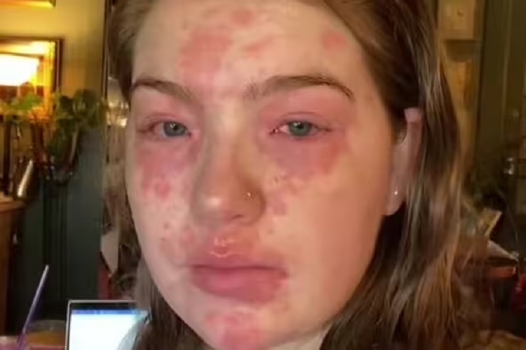 Mujer afirma que es alérgica a su novio