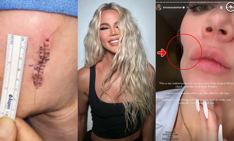 Khloe Kardashian luce enorme cicatriz tras extirparse un melanoma