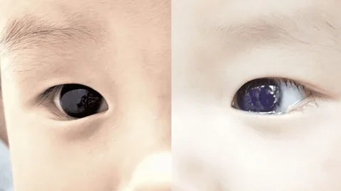 Un bebé cambió el color de los ojos luego de un tratamiento para el covid-19
