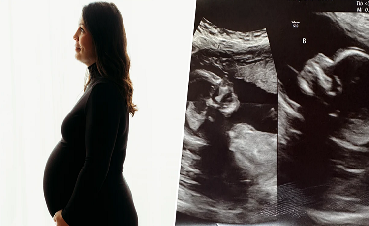 Mujer con raro útero doble queda embarazada en ambos a la vez
