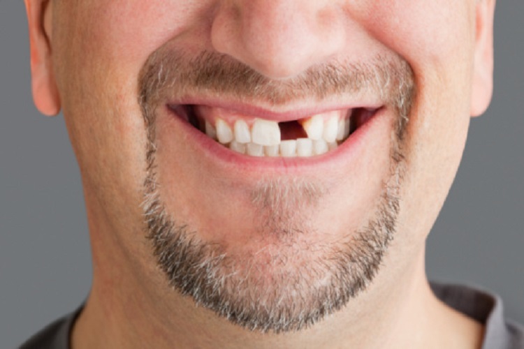 Medicamento japones podría regenerar dientes perdidos