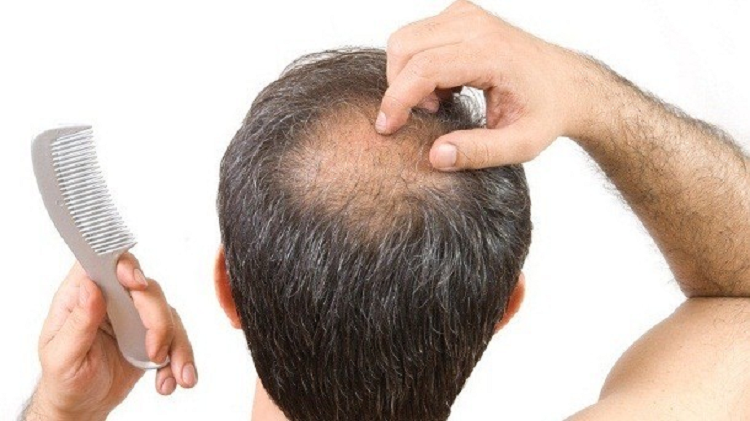 Prueban una vacuna que podría acabar con la alopecia