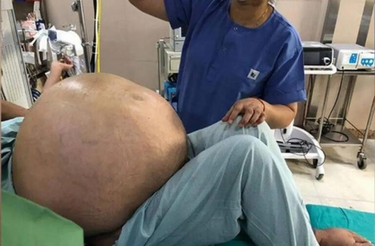 Extirpan con éxito un tumor de 50 kilos de peso del abdomen a una mujer