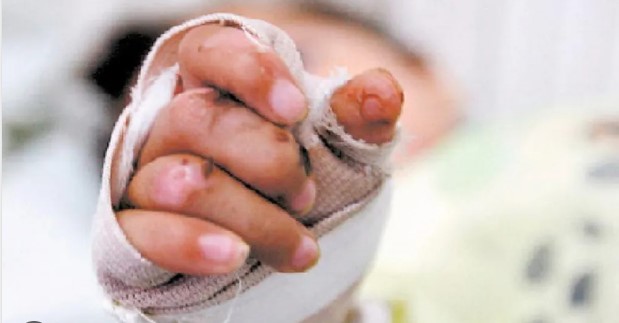 Niño sufre quemaduras tras la explosión de un celular en la población de Macuare