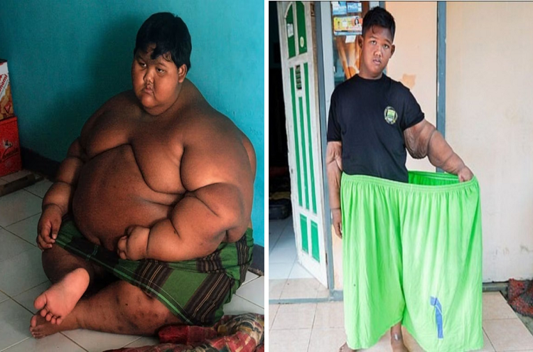 El impactante cambio físico de ‘el niño más gordo del mundo’
