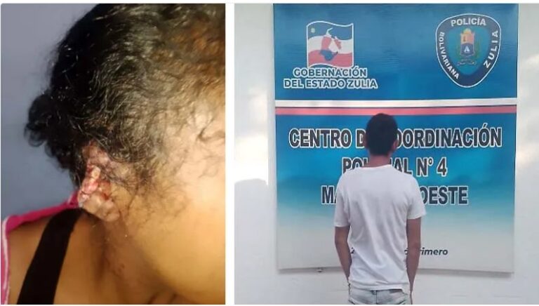 Atacó a mordiscos a su pareja y le quitó parte de la oreja en Maracaibo