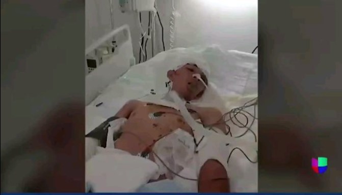 Venezolano que cayó del Tren «La Bestía» y perdió sus piernas permanece inconsciente en México