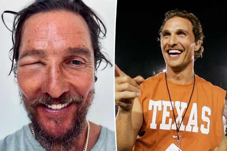 Matthew McConaughey comparte impactante imagen de su ojo hinchado