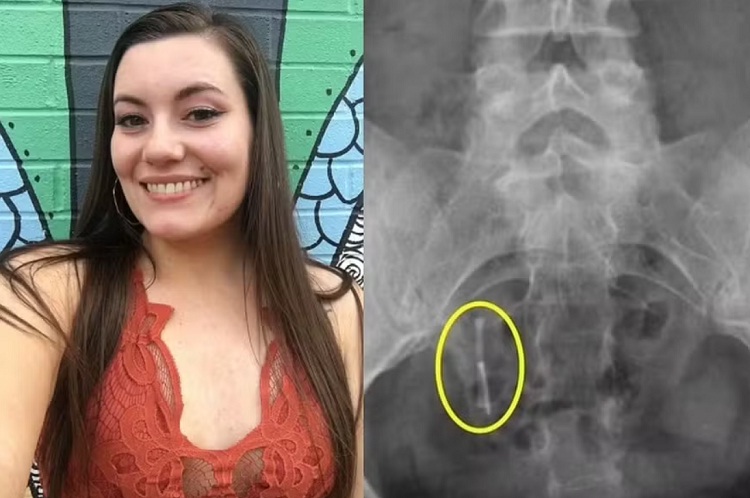 Mujer perdió su dispositivo intrauterino y 12 años después aparece en su colon