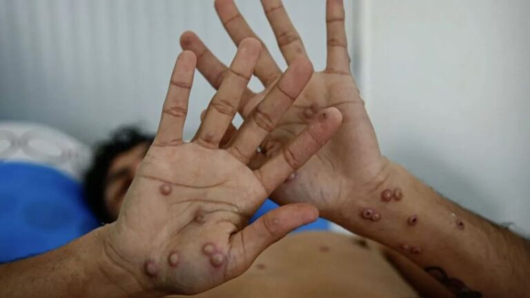 Filipinas reporta su primer caso de mpox en 2024